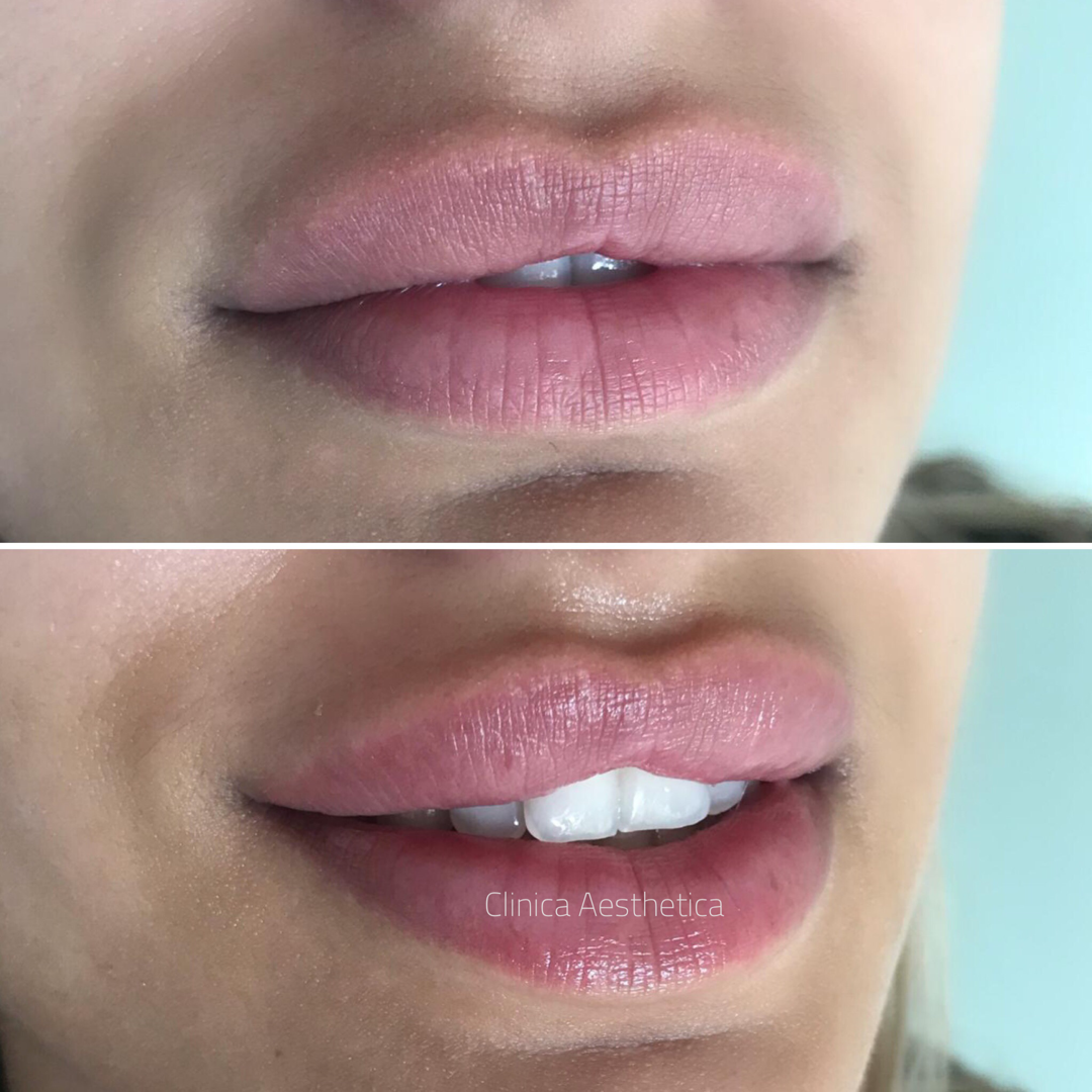 Augmentarea buzelor cu acid hialuronic – tot ce trebuie sa stiti! - Clinica Zetta